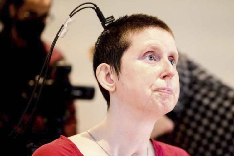 Una mujer vuelve a hablar tras 18 años gracias a un implante cerebral con IA