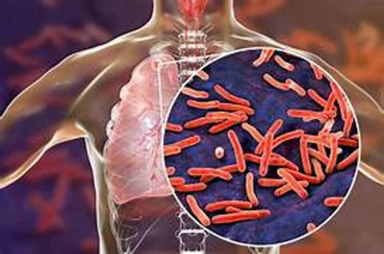 Aumentaron un 38% los casos de tuberculosis en Argentina